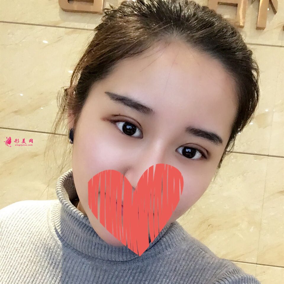 北京双眼皮修复:魏志香医生