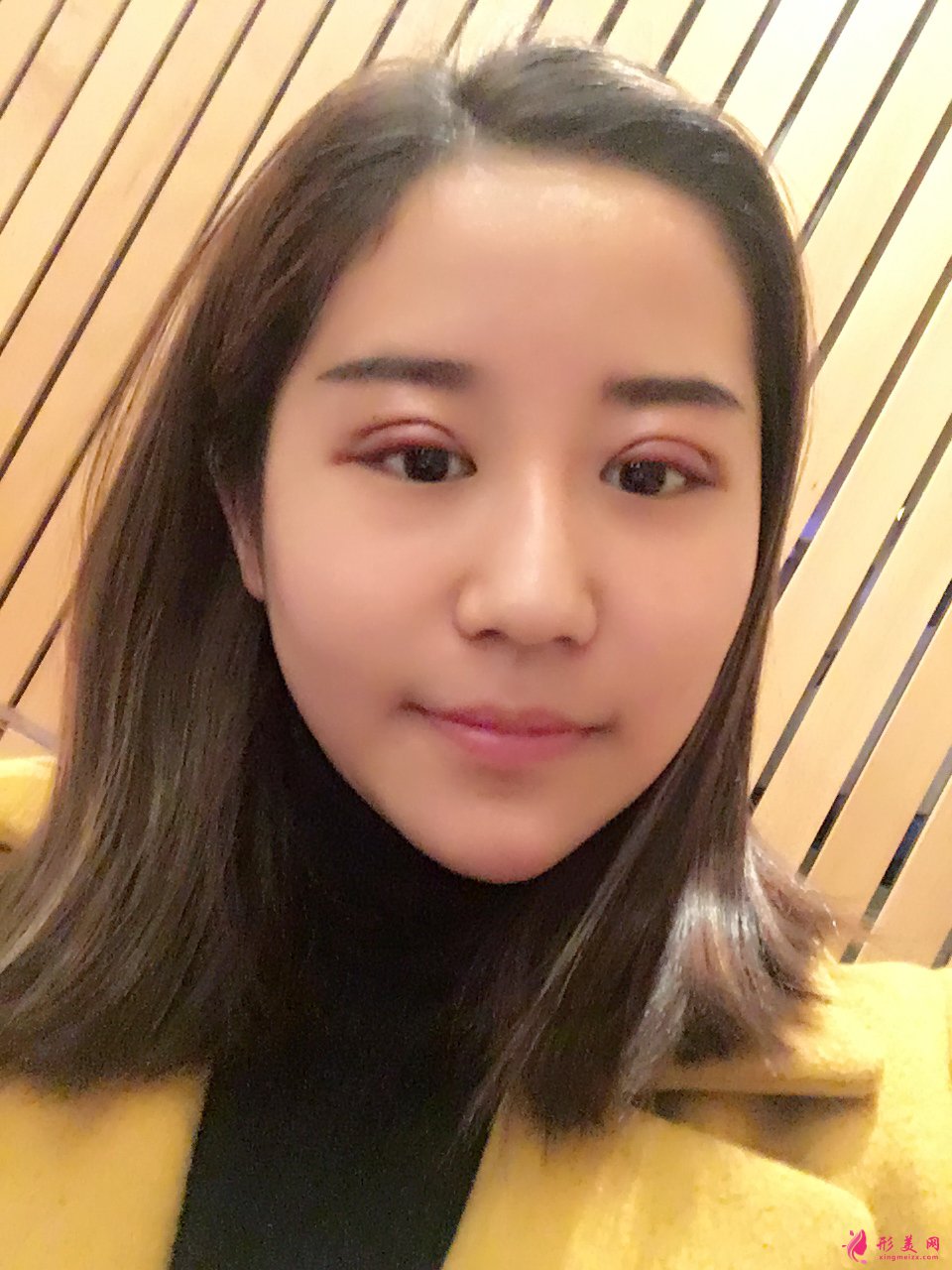 北京双眼皮修复:魏志香医生