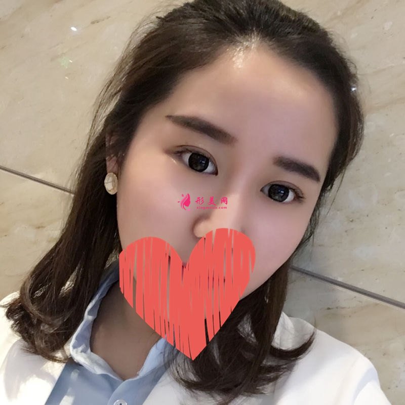 北京双眼皮修复:魏志香医生