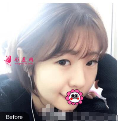 在深圳阳光医院做双眼皮手术前