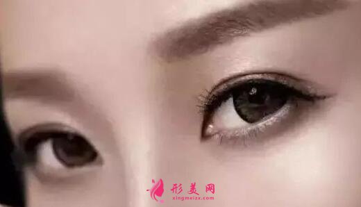 韩式三点式好吗?简单概括一下韩式三点双眼皮的优势!