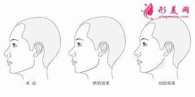 南宁下颌角切除真的可以让脸变小吗?