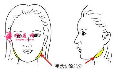 南宁下颌角切除真的可以让脸变小吗?