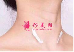 激光祛斑的效果如何?为什么肌肤会出现反黑现象?
