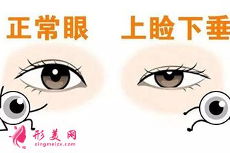 上睑下垂矫正术怎么样?矫正容貌美丽一生