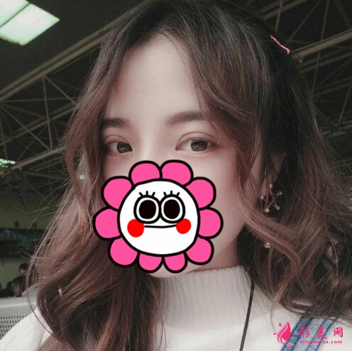 石家庄美联臣怎么样?双眼皮案例