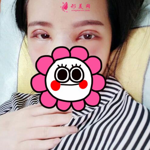 石家庄美联臣怎么样?双眼皮案例