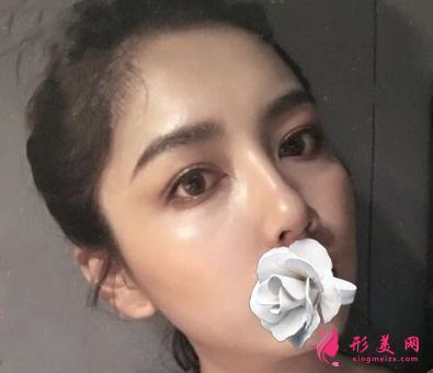 武汉同济整形王海平隆鼻怎么样？前后60天对比图 案例分享