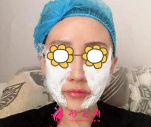 武汉同济整形王海平隆鼻怎么样？前后60天对比图 案例分享