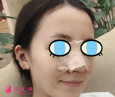 武汉同济整形王海平隆鼻怎么样？前后60天对比图 案例分享