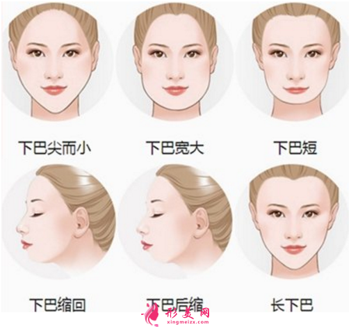都说膨体容易感染,膨体垫下巴到底值不值得做?