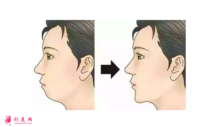 都说膨体容易感染,膨体垫下巴到底值不值得做?