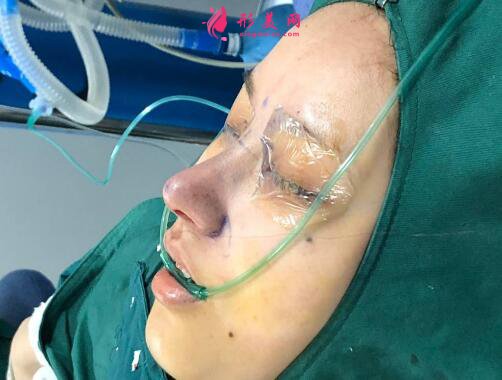 成都赵善军博士整形美容门诊部自体脂肪隆胸案例