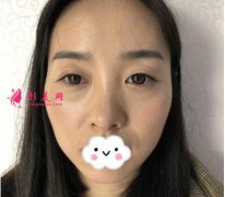 关于隆鼻的真实案例 相信很多朋友都在等我的分享