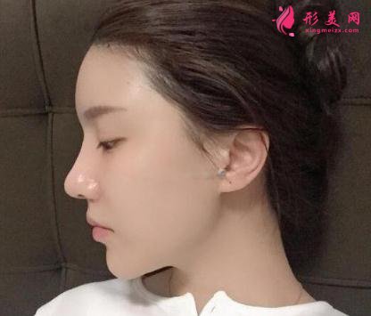 成都美立方整形医院隆鼻案例 术后恢复效果反馈 