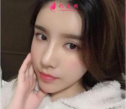 成都美立方整形医院隆鼻案例 术后恢复效果反馈 