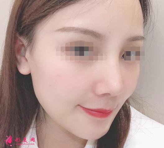 北京假体隆鼻修复手术日记,鼻子的重生记录!