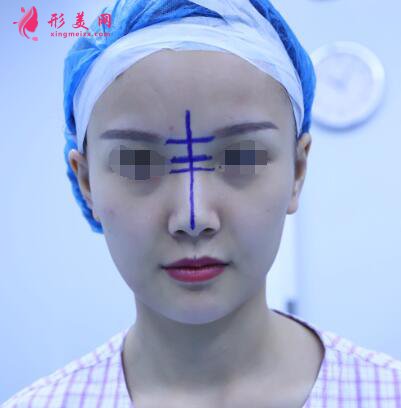 北京假体隆鼻修复手术日记,鼻子的重生记录!