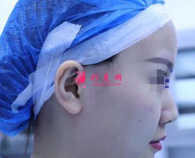 北京假体隆鼻修复手术日记,鼻子的重生记录!