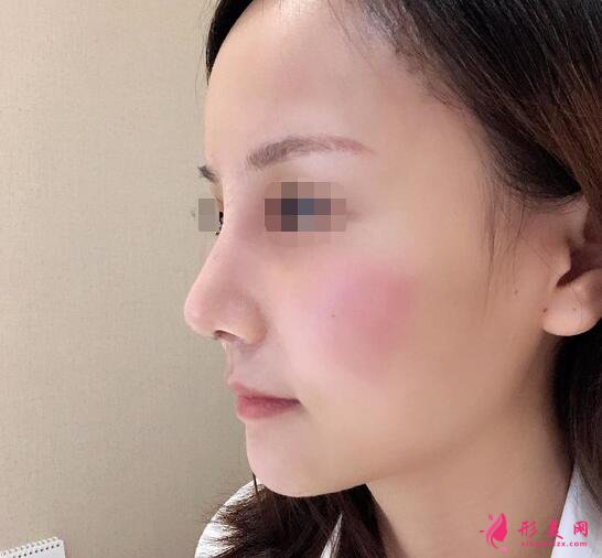 北京假体隆鼻修复手术日记,鼻子的重生记录!