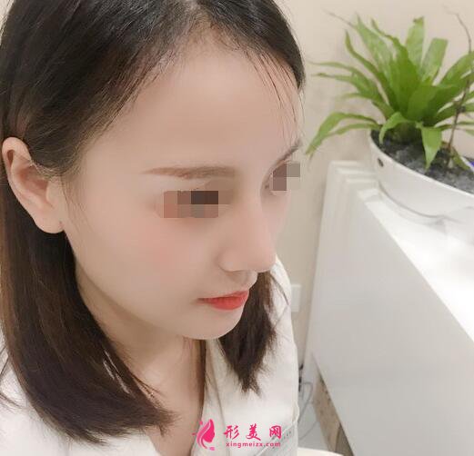 北京假体隆鼻修复手术日记,鼻子的重生记录!