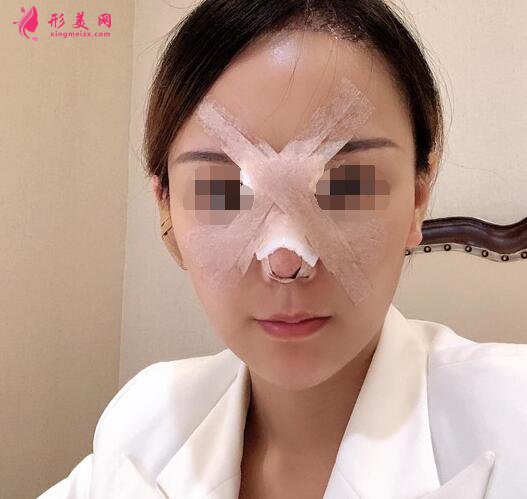 北京假体隆鼻修复手术日记,鼻子的重生记录!