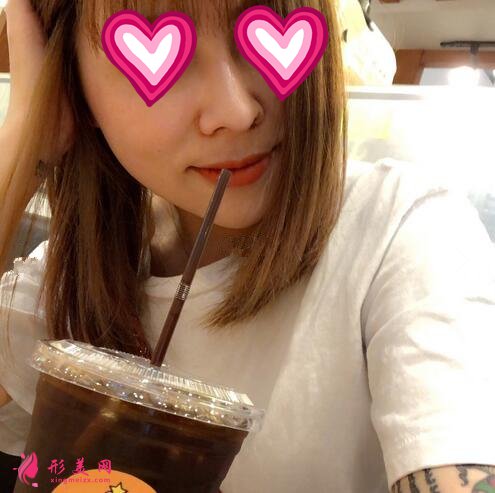 北大深圳医院隆鼻案例图锦集,塌鼻子两个月逆袭初恋脸!