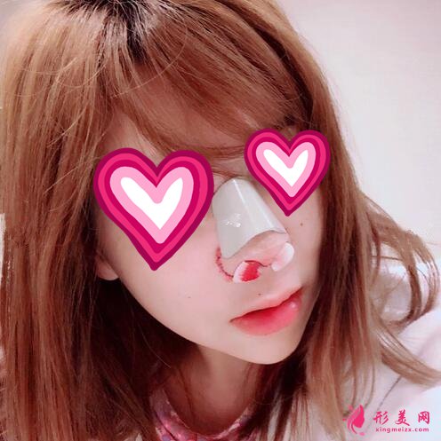 北大深圳医院隆鼻案例图锦集,塌鼻子两个月逆袭初恋脸!