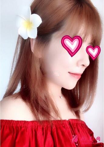 北大深圳医院隆鼻案例图锦集,塌鼻子两个月逆袭初恋脸!