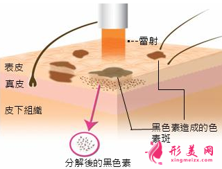 激光治疗黄褐斑每次要间隔多久