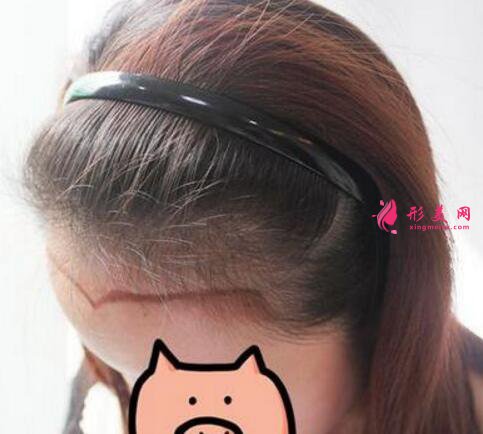 毛发移植手术效果图，发际线种植