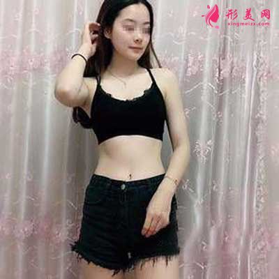 在郑州悦美整形美容医院做吸脂瘦腰腹+瘦大腿手术后1个月