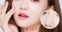 上海华美整形医院鼻翼缩小手术修复多少钱？
