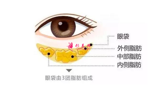 做去眼袋手术多少钱?有哪些方法?