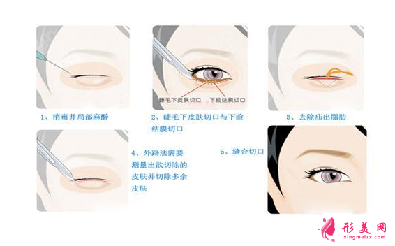 做去眼袋手术多少钱?有哪些方法?