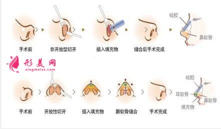 鼻翼整形的价格是多少?术后注意事项~