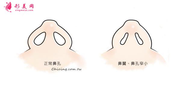 鼻翼整形的价格是多少?术后注意事项~