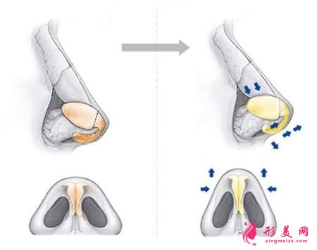鼻翼整形的价格是多少?术后注意事项~