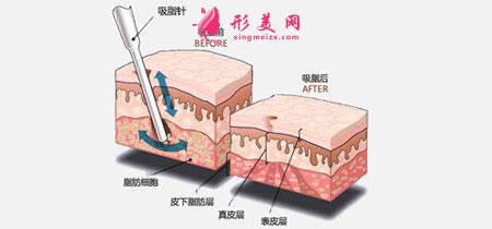 手臂吸脂术安全吗?吸脂一次多少钱?