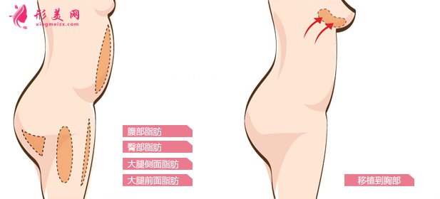 自体脂肪隆胸好吗?术前准备工作要知道!