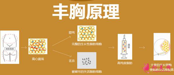 自体脂肪隆胸好吗?术前准备工作要知道!