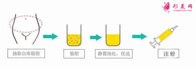 自体脂肪隆胸好吗?术前准备工作要知道!