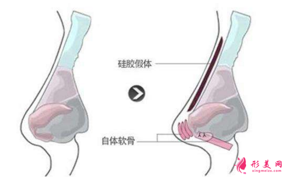 【术前科普】硅胶垫鼻梁多久要取出来?