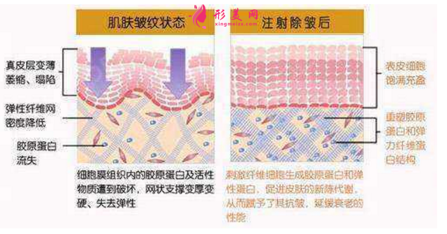 注射除皱效果怎么样?附术前术后注意事项!