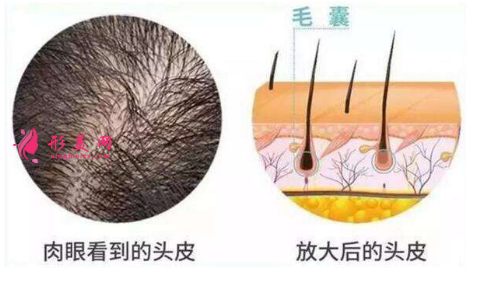 头发种植效果可靠吗?术前注意事项大全!