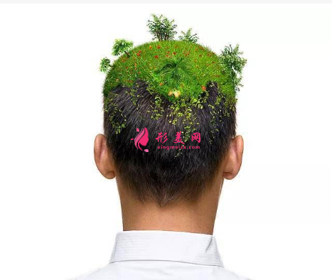 头发种植效果可靠吗?术前注意事项大全!