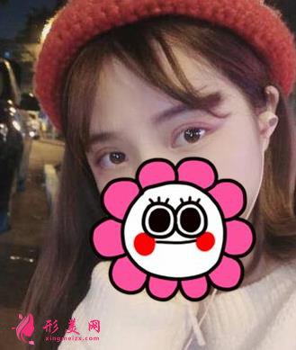 重庆附一院整形科张恒术双眼皮案例可参考:效果不让你们失望!