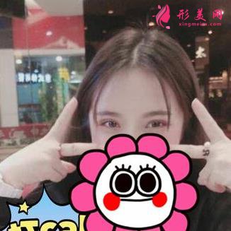 重庆附一院整形科张恒术双眼皮案例可参考:效果不让你们失望!