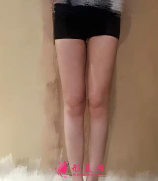 郑大二附院整形科刘月丽抽脂怎么样?大腿抽脂案例来查看!