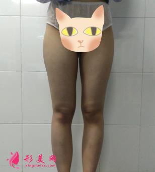 郑大二附院整形科刘月丽抽脂怎么样?大腿抽脂案例来查看!